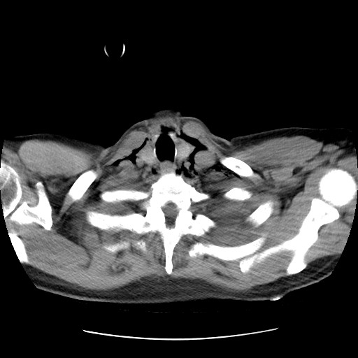 File:Boerhaave syndrome (Radiopaedia 59796-67310 Axial liver window 8).jpg
