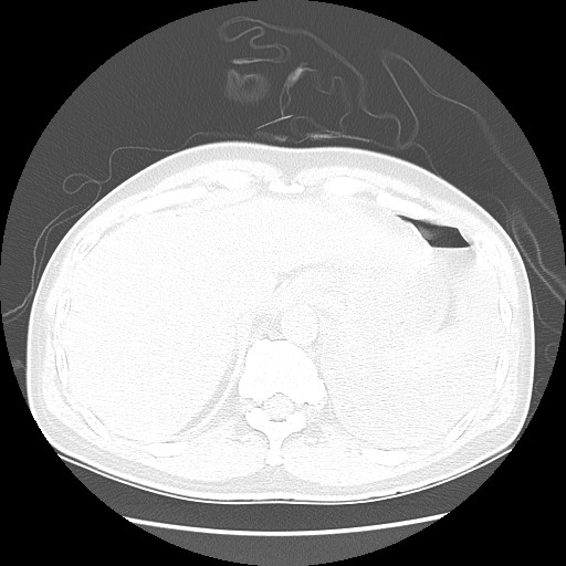 Boerhaave syndrome (Radiopaedia 59796-67310 Axial lung window 55).jpg