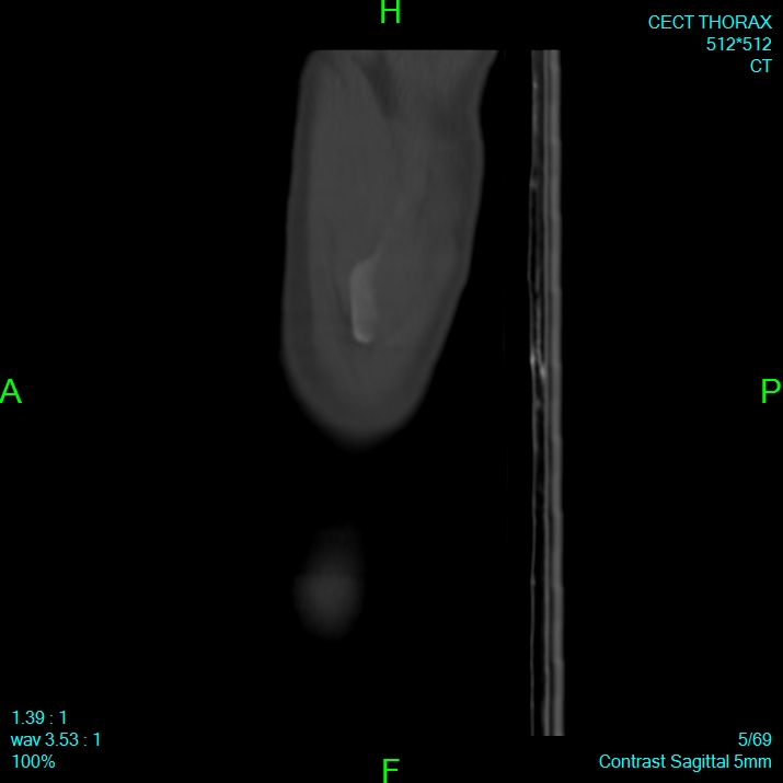 Bone metastases from lung carcinoma (Radiopaedia 54703-60937 Sagittal bone window 5).jpg