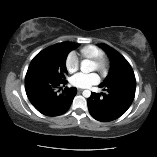 Borderline mucinous tumor (ovary) (Radiopaedia 78228-90808 A 26).jpg