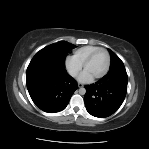 File:Borderline mucinous tumor (ovary) (Radiopaedia 78228-90808 A 59).jpg