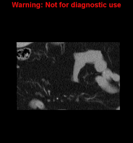 File:Bosniak renal cyst - type IV (Radiopaedia 23402-23466 C 7).jpg