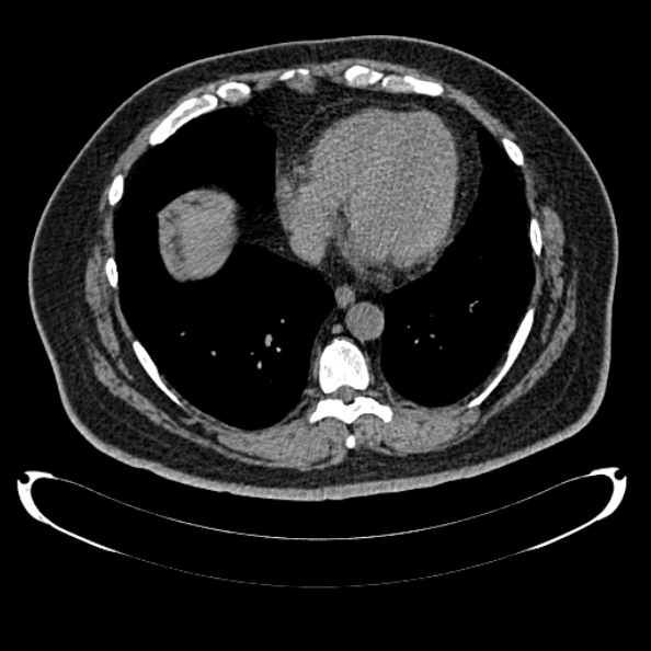 Bosniak renal cyst - type IV (Radiopaedia 24244-24518 Axial non-contrast 5).jpg