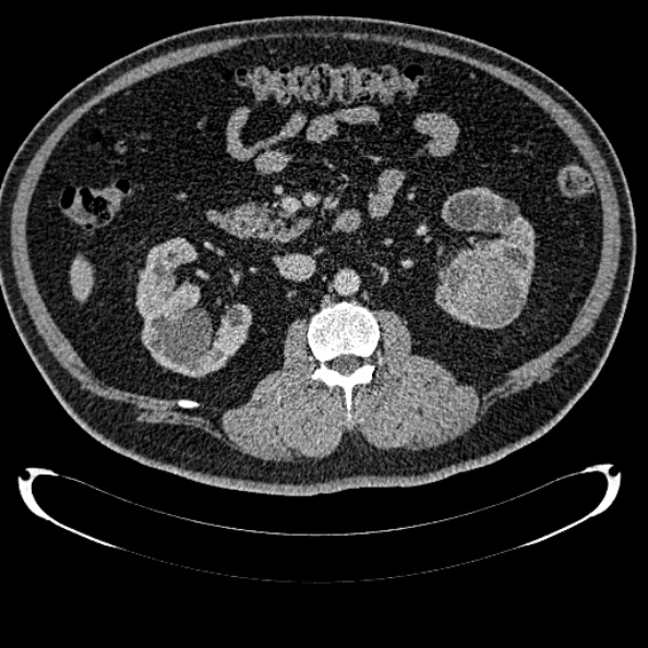 File:Bosniak renal cyst - type IV (Radiopaedia 24244-24518 C 160).jpg