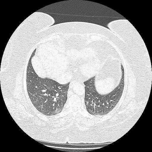 Bovine aortic arch - right internal mammary vein drains into the superior vena cava (Radiopaedia 63296-71875 Axial lung window 119).jpg