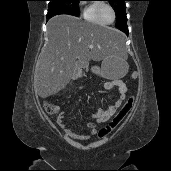 Bowel and splenic infarcts in acute lymphocytic leukemia (Radiopaedia 61055-68913 B 23).jpg