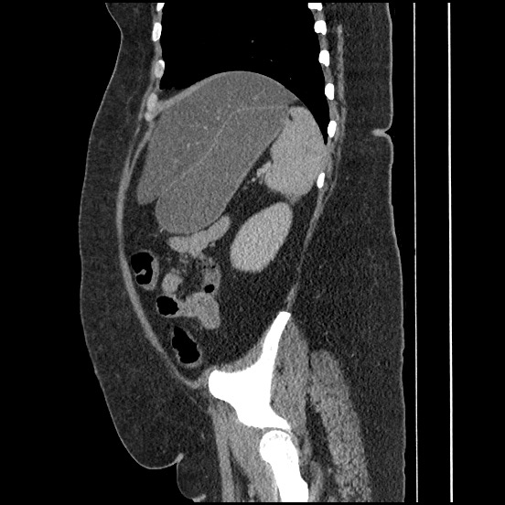 Bowel and splenic infarcts in acute lymphocytic leukemia (Radiopaedia 61055-68913 C 25).jpg