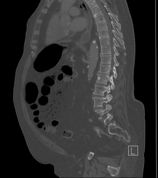 Bowel ischemia secondary to SMA occlusion with extensive portomesenteric venous gas (Radiopaedia 54656-60871 Sagittal bone window 47).jpg
