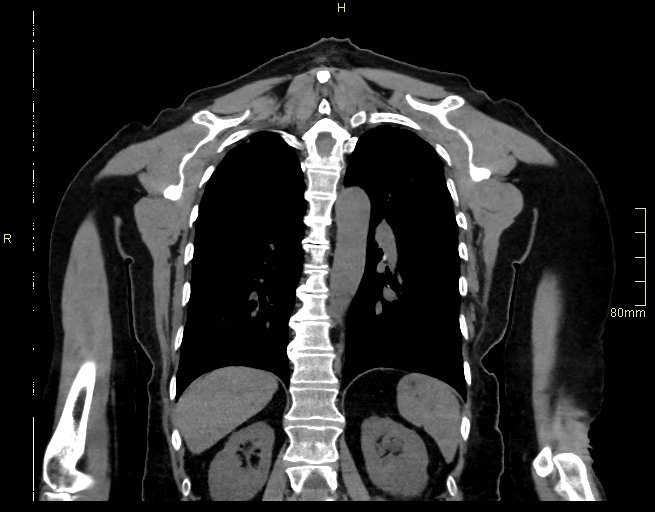 Brachial artery foreign body (Radiopaedia 54583-60820 Coronal non-contrast 42).jpg