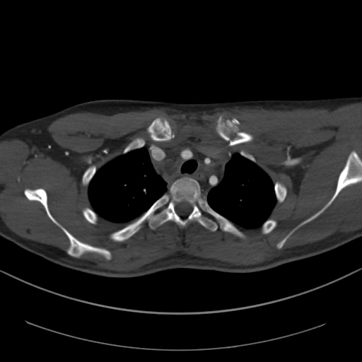 File:Brachiocephalic trunk pseudoaneurysm (Radiopaedia 70978-81191 Axial bone window 55).jpg