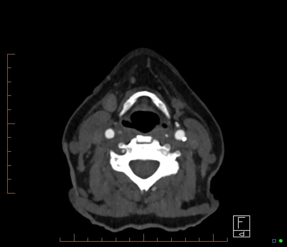 Brachiocephalic trunk stenosis (Radiopaedia 87242-103519 A 98).jpg