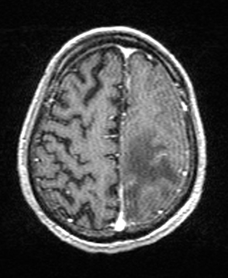 Brain abscess with dual rim sign (Radiopaedia 87566-103938 Axial T1 C+ 127).jpg