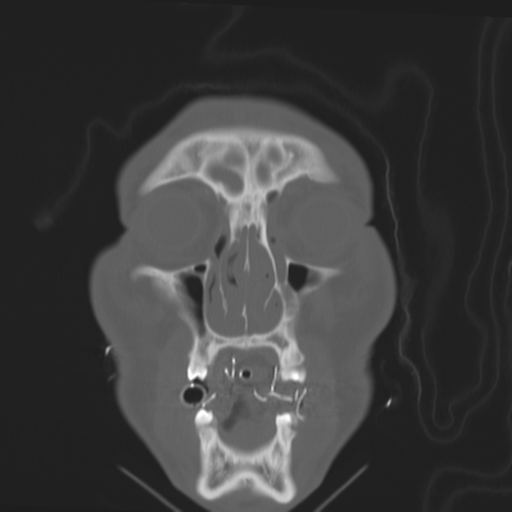 File:Brain contusions, internal carotid artery dissection and base of skull fracture (Radiopaedia 34089-35339 Coronal bone window 15).png