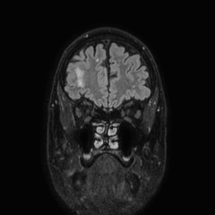 Brain metastases from lung cancer (Radiopaedia 83839-99028 Coronal FLAIR 13).jpg