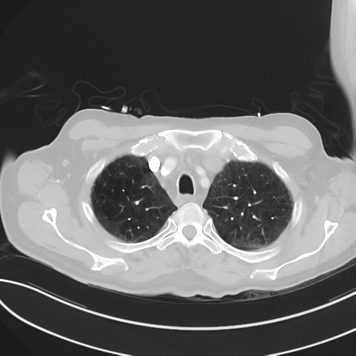 File:Brain metastasis (lung cancer) (Radiopaedia 48289-53180 Axial lung window 13).png