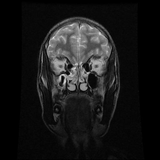 File:Brainstem glioma (Radiopaedia 30923-31624 Coronal T2 17).jpg