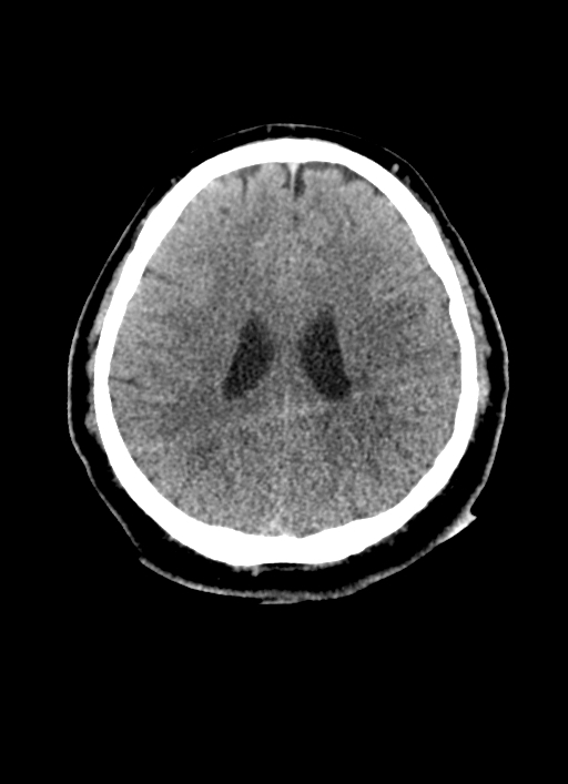 Brainstem hemorrhage (Radiopaedia 81294-94976 Axial non-contrast 24).jpg