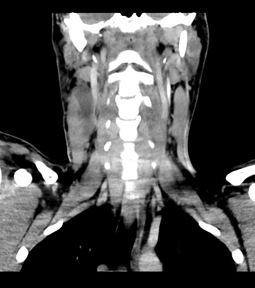 Branchial cleft cyst (Radiopaedia 31167-31875 Coronal C+ delayed 36).jpg