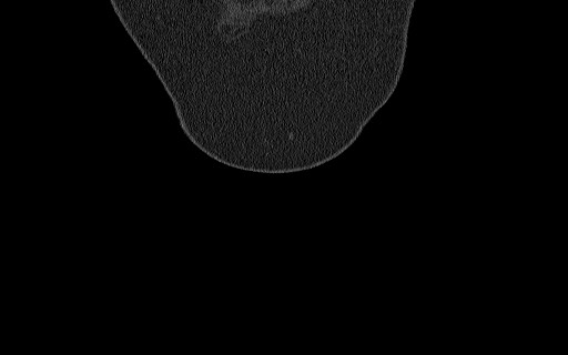 Breast carcinoma with pathological hip fracture (Radiopaedia 60314-67993 Coronal bone window 21).jpg