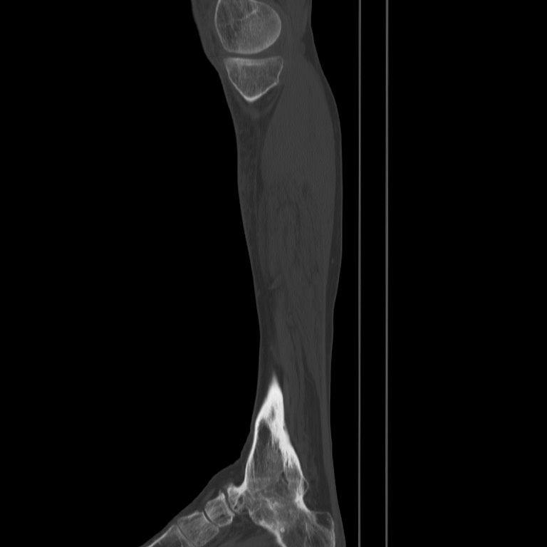 Brodie abscess - tibia (Radiopaedia 66028-75204 Sagittal bone window 8).jpg