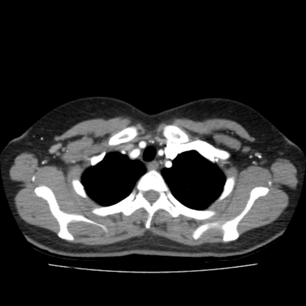Bronchial atresia (Radiopaedia 22965-22992 D 45).jpg