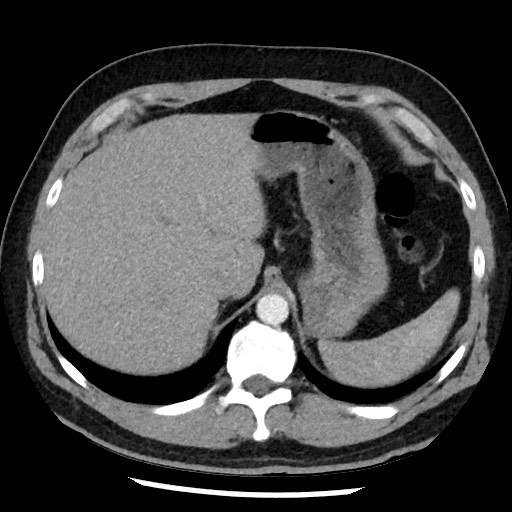 Bronchial carcinoid tumor (Radiopaedia 67377-76764 A 56).jpg