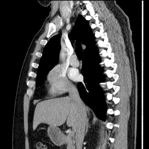 Bronchial carcinoid tumor (Radiopaedia 67377-76764 E 31).jpg