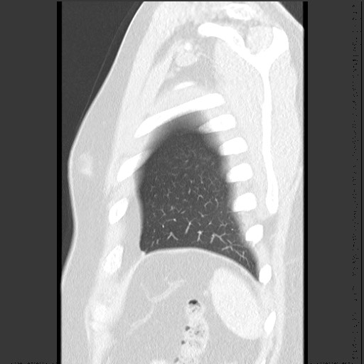 Bronchial carcinoid tumor (Radiopaedia 67377-76764 Sagittal lung window 61).jpg