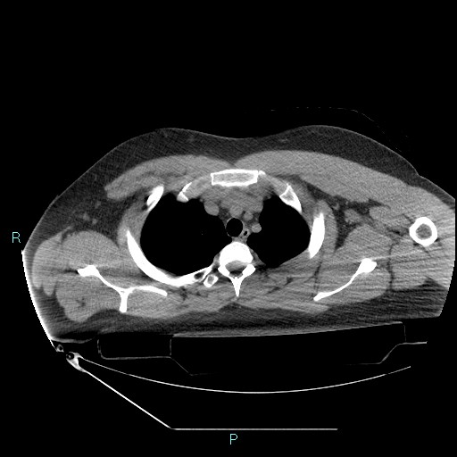 Bronchial carcinoid tumor (Radiopaedia 78272-90870 Axial non-contrast 20).jpg