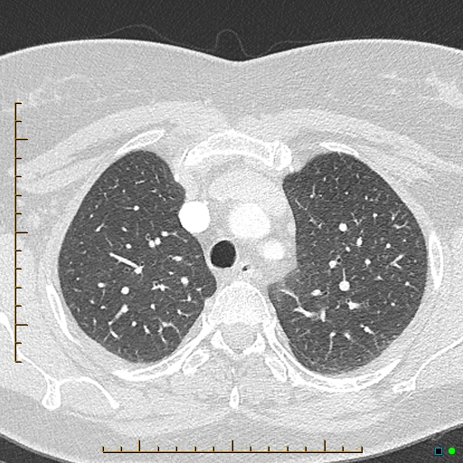Bronchial diverticula (Radiopaedia 79512-92676 Axial lung window 40).jpg