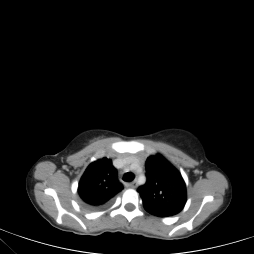 Bronchial mucoepidermoid carcinoma (Radiopaedia 57023-63895 Axial 27).jpg