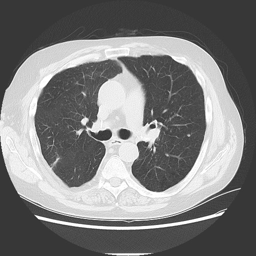 Bronchial stenosis - lung transplant (Radiopaedia 73133-83848 Axial lung window 28).jpg