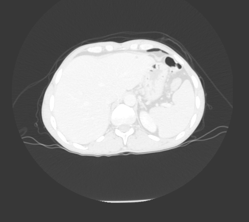 File:Bronchiectasis in Crohn disease (Radiopaedia 60311-67977 Axial lung window 36).jpg