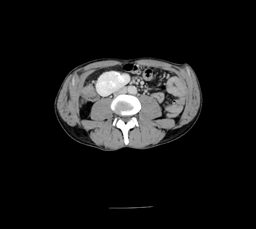 File:Bronchiectasis in Crohn disease (Radiopaedia 60311-67977 B 95).jpg