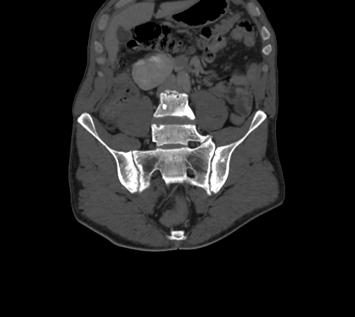 Bronchiectasis in Crohn disease (Radiopaedia 60311-67977 Coronal bone window 25).jpg