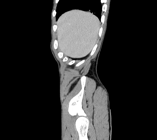 File:Bronchiectasis in Crohn disease (Radiopaedia 60311-67977 D 7).jpg
