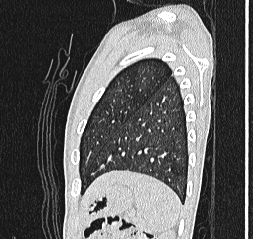 Bronchiolitis obliterans (Radiopaedia 71538-81897 Sagittal lung window 60).jpg