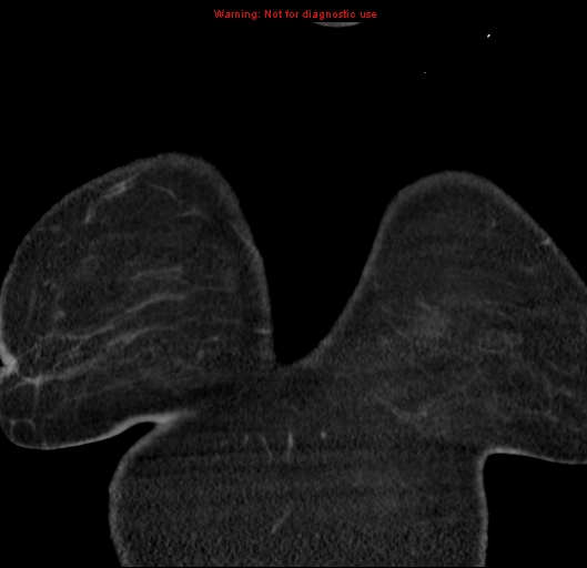 Bronchoalveolar carcinoma (BAC) (Radiopaedia 13436-13392 E 1).jpg