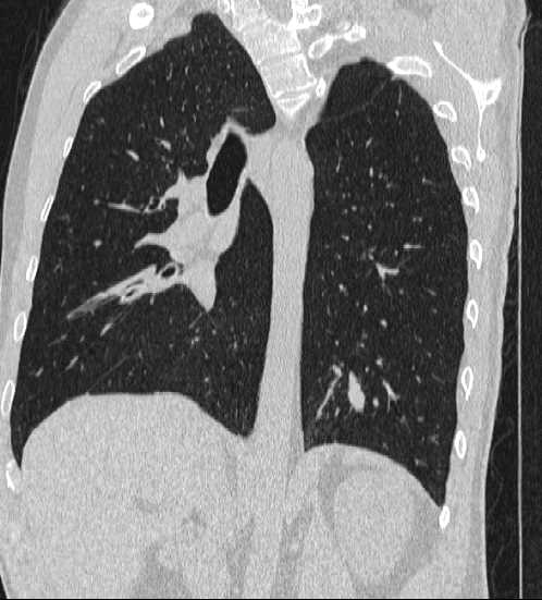 File:Bronchocele (Radiopaedia 60676-68429 Oblique lung window 22).jpg