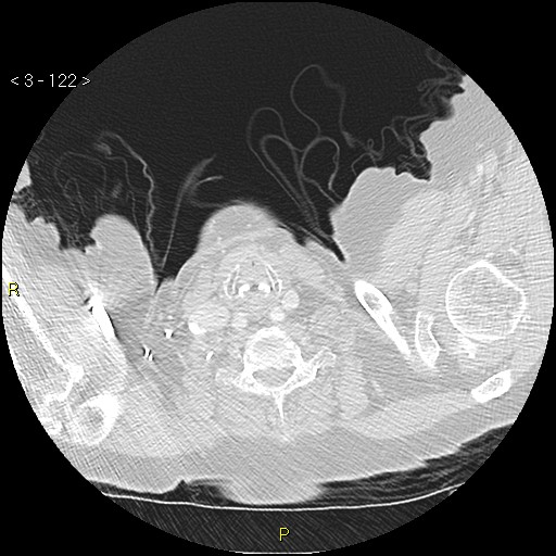 Bronchogenic carcinoma as an incidental finding (Radiopaedia 16453-16130 Axial lung window 122).jpg