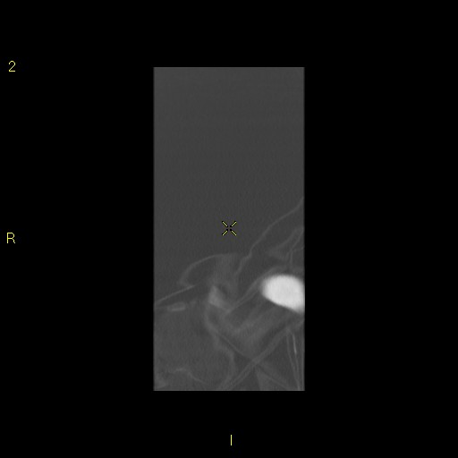 File:Bronchogenic carcinoma as an incidental finding (Radiopaedia 16453-16130 Coronal lung window 3).jpg