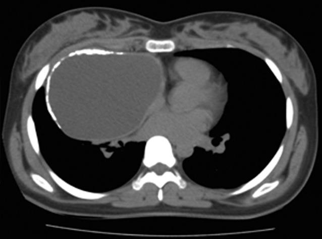File:Bronchogenic cyst (Radiopaedia 22985-23021 Axial non-contrast 1).jpg