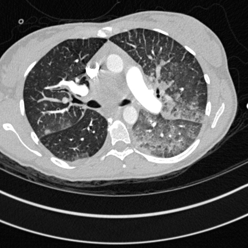 Bronchogenic cyst (Radiopaedia 77801-90071 Axial lung window 23).jpg
