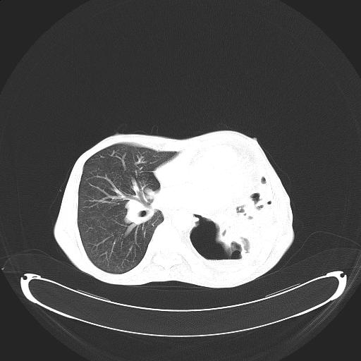 File:Bronchopleural fistula secondary to tuberculosis (Radiopaedia 20415-20322 Coronal lung window 2).jpg