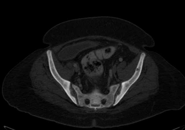 Brown tumors compressing the spinal cord (Radiopaedia 68442-77988 G 101).jpg