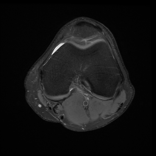 File:Bucket-handle meniscus tear (Radiopaedia 65700-74809 Axial PD fat sat 14).jpg