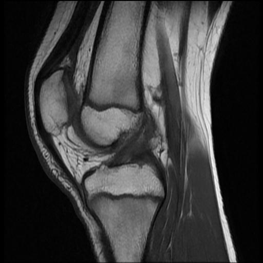 File:Bucket handle tear - lateral meniscus (Radiopaedia 72124-82634 Sagittal T1 8).jpg