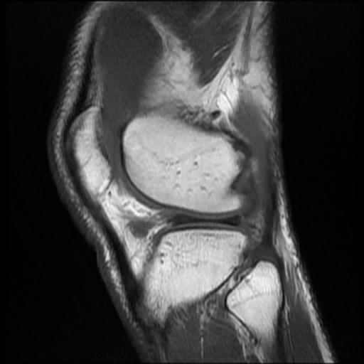 File:Bucket handle tear - medial meniscus (Radiopaedia 69245-79026 Sagittal T1 3).jpg