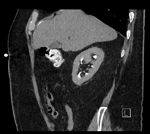 Buried bumper syndrome - gastrostomy tube (Radiopaedia 63843-72577 Sagittal Inject 89).jpg