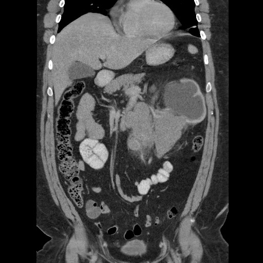 Burned-out testicular seminoma - retroperitoneal nodal metastases (Radiopaedia 62872-71245 B 27).jpg